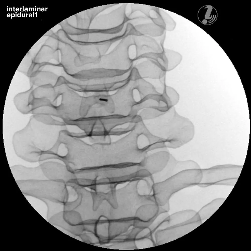 Image Guided Cervical Spine Injection Trainer